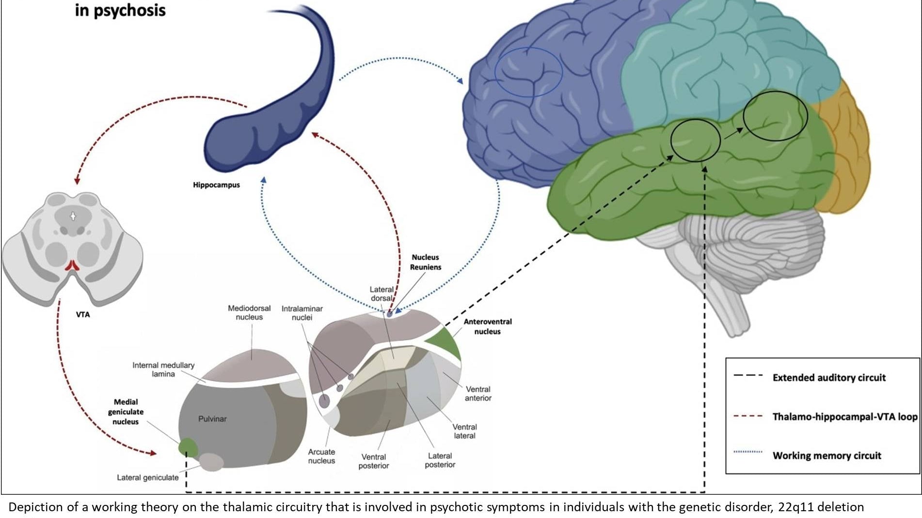 Alucinações auditivas na esquizofrenia ligadas à conectividade cerebral aberrante - IBNeuro