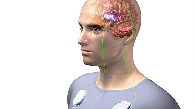 Estimulação cerebral profunda melhora os sintomas da depressão - IBNeuro