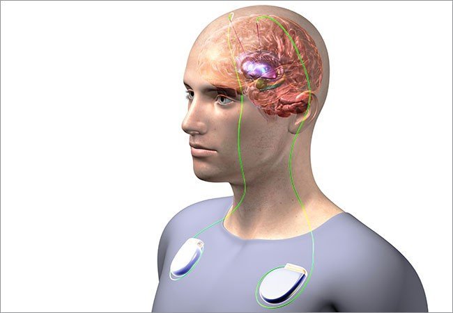 Estimulação cerebral profunda melhora os sintomas da depressão - IBNeuro