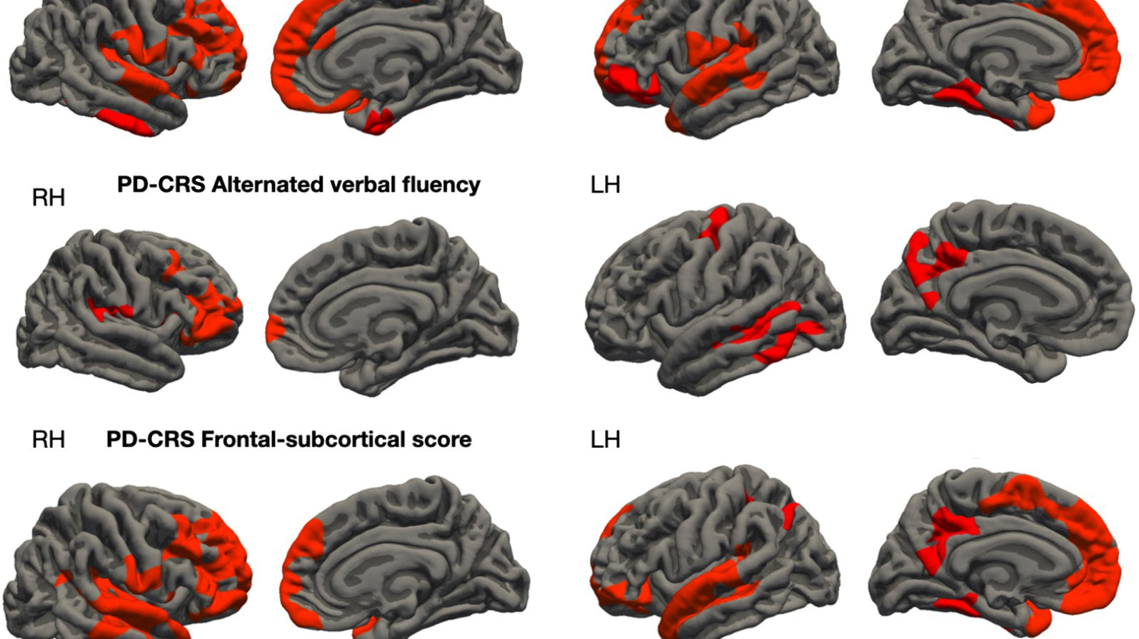 Morfologia Cerebral e Déficits Cognitivos na Doença de Parkinson: Correlatos Neuroanatômicos dos Escores PD-CRS em Pacientes com Comprometimento Cognitivo Leve