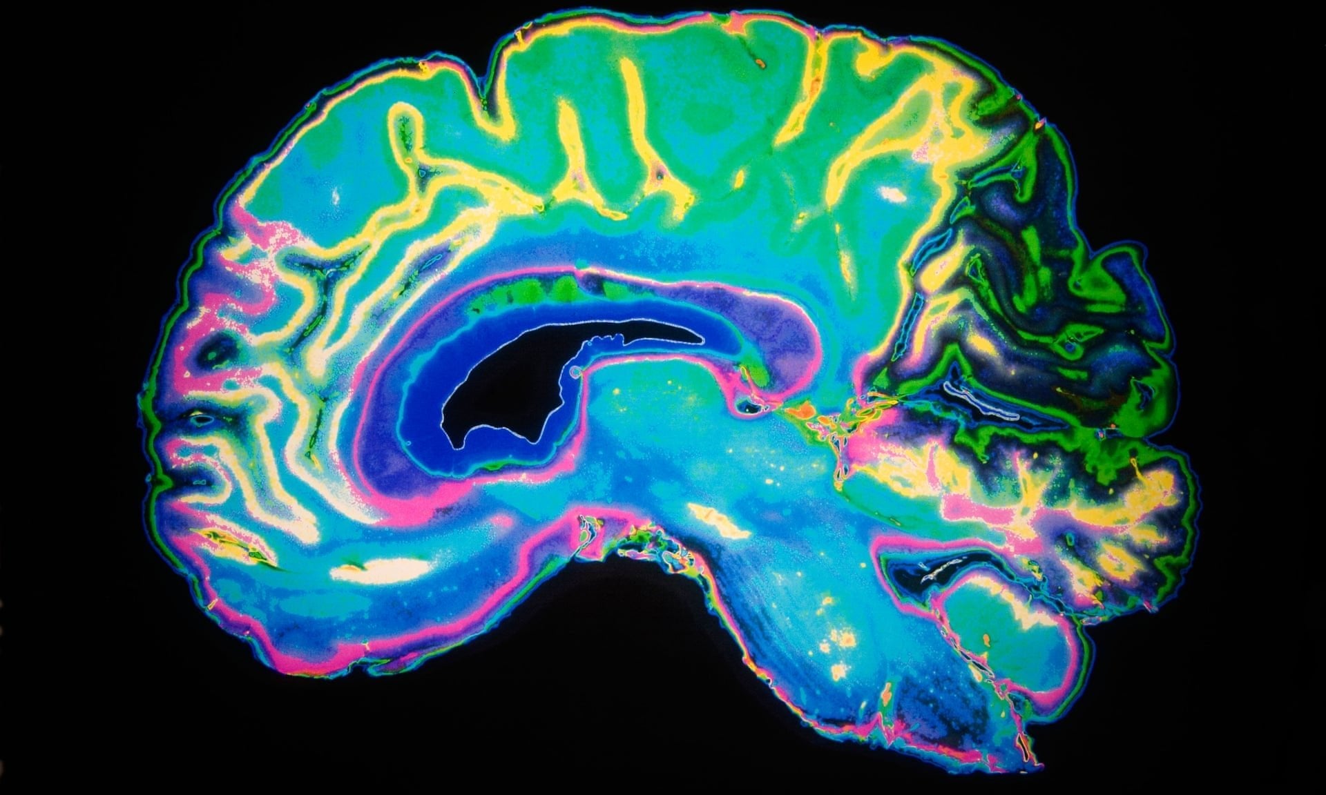 Pessoas com sintomas leves de coronavírus podem apresentar distúrbios cerebrais graves - IBNeuro