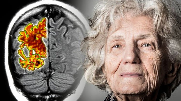 Transtorno neurocognitivo - IBNeuro