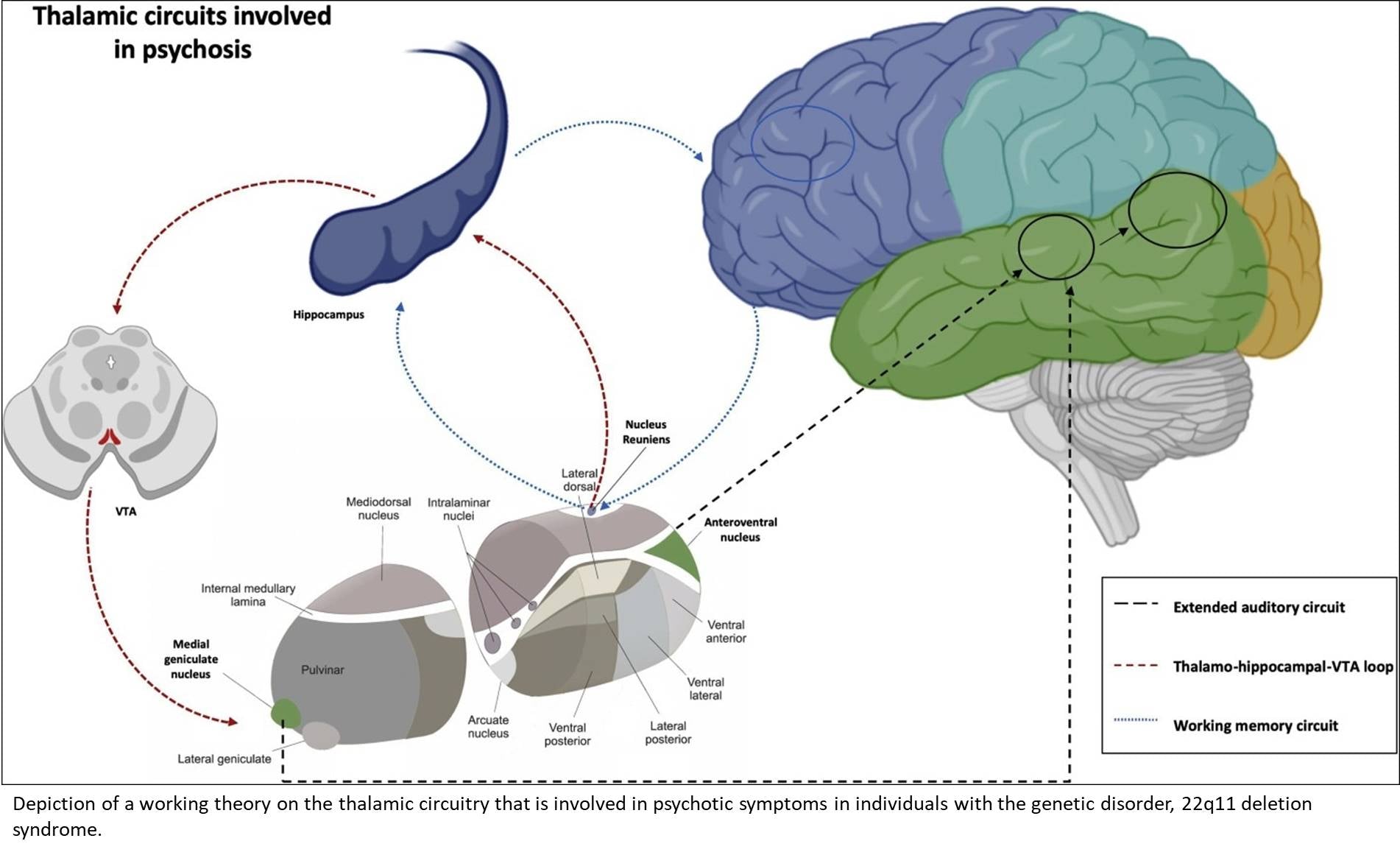 Alucinações auditivas na esquizofrenia ligadas à conectividade cerebral aberrante - IBNeuro