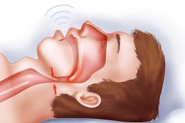 Efeitos da apneia do sono na cognição - IBNeuro