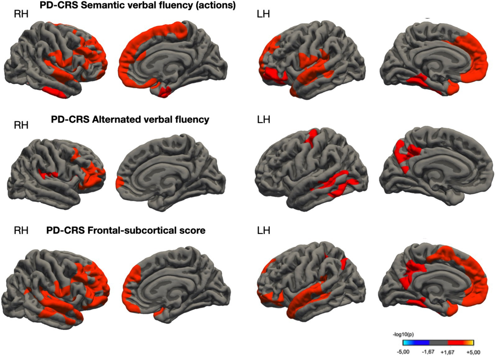 Morfologia Cerebral e Déficits Cognitivos na Doença de Parkinson: Correlatos Neuroanatômicos dos Escores PD-CRS em Pacientes com Comprometimento Cognitivo Leve